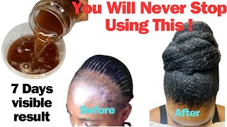 Not a Single Hair Strand Will Fall Out After Using This Hair Tea. Use Twice a Week & Don't Rinse Out