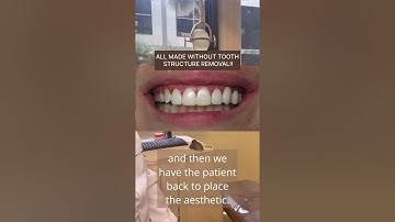 Bioclear Cosmetic veneers: what are they, require no tooth grinding, they look so good, best for you
