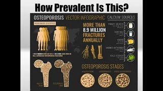 Osteoporosis Factors You Need To Know In Order To Preserve Bone Health