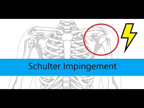 Schulter Impingement Erklärung