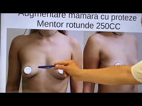 Augmentare mamară cu proteze Mentor rotunde 250CC