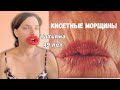 кисетные морщины