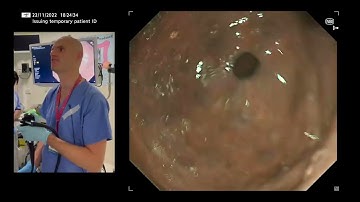 LLE 2022 Case: UGI - Chronic Atrophic Gastritis and Early Gastric Cancer