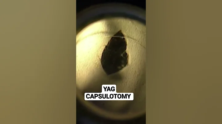 YAG CAPSULOTOMY