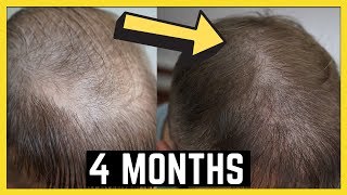 4 Months after my 2nd FUE Hair Transplant! Matt Dominance