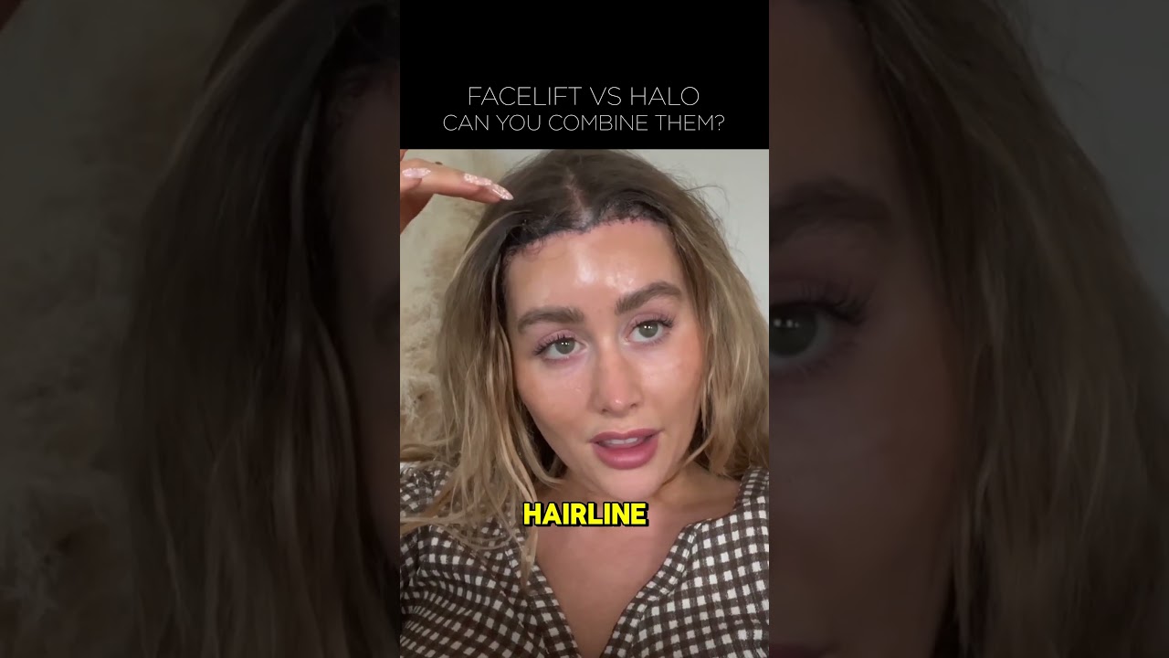 Facelift vs Hairline Lowering Surgery - Can You Combine Them? | Greg Bran