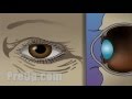 Small incision cataract surgery preop patient education