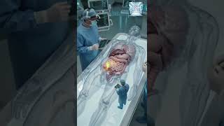 Operation Theatre Me Appendix Kaise Nikala Jata Hai?