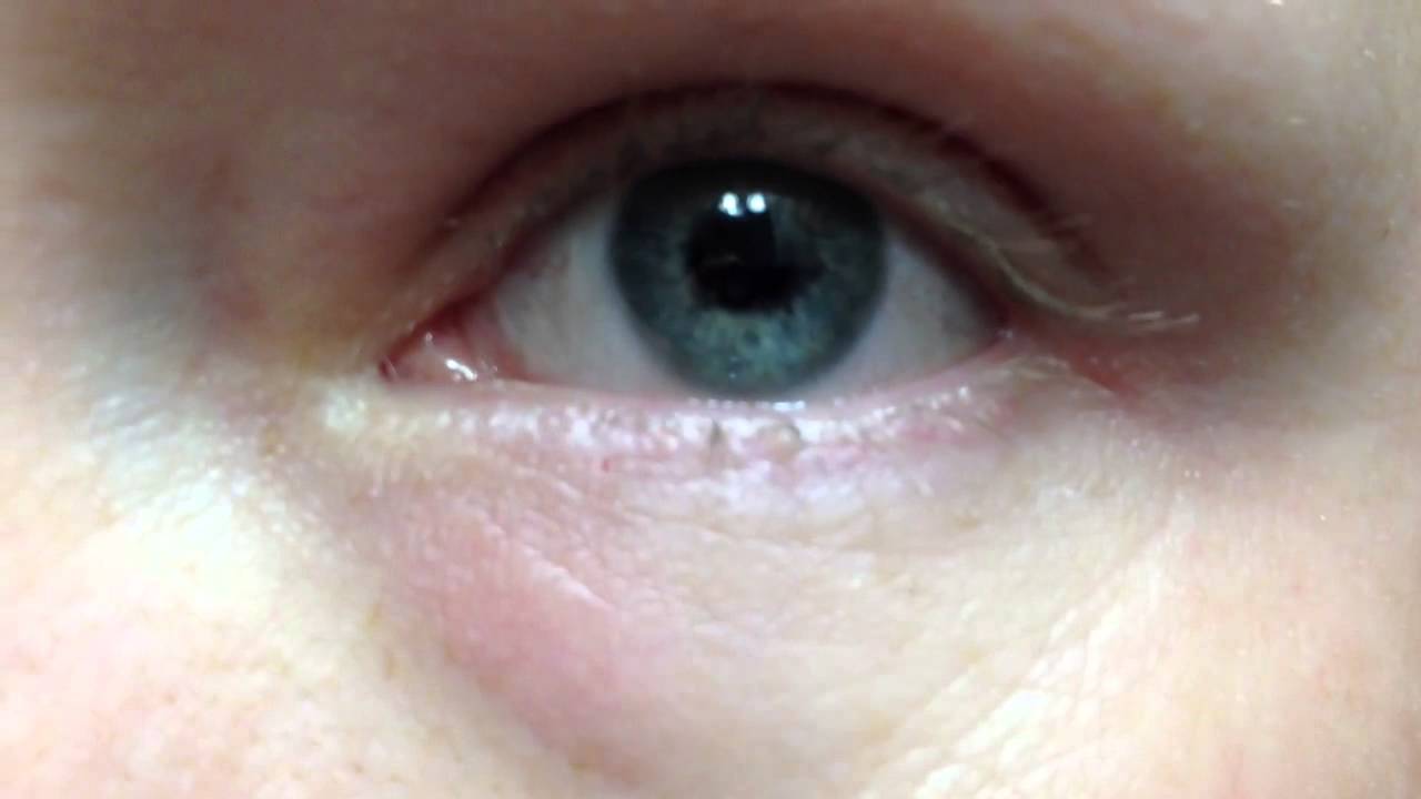 AAAAGGGGHHHH! Eye twitching! - YouTube