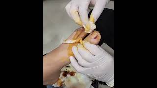 Dirnagin Kenarinda Etin Sismesi Dirnaq Qiraginda Et Boyumesi Dirnaq Batmasi Onikokriptoz Mualice Ev