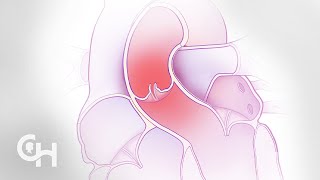 Aortic Valve Repair In Children And Teens