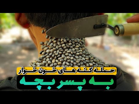 حمله کنه های خون خوار به پسر بچه - ticks on human