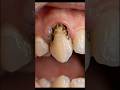 Gumline Cavity Restoration 🦷 | Satisfying Dental Transformation #shorts
