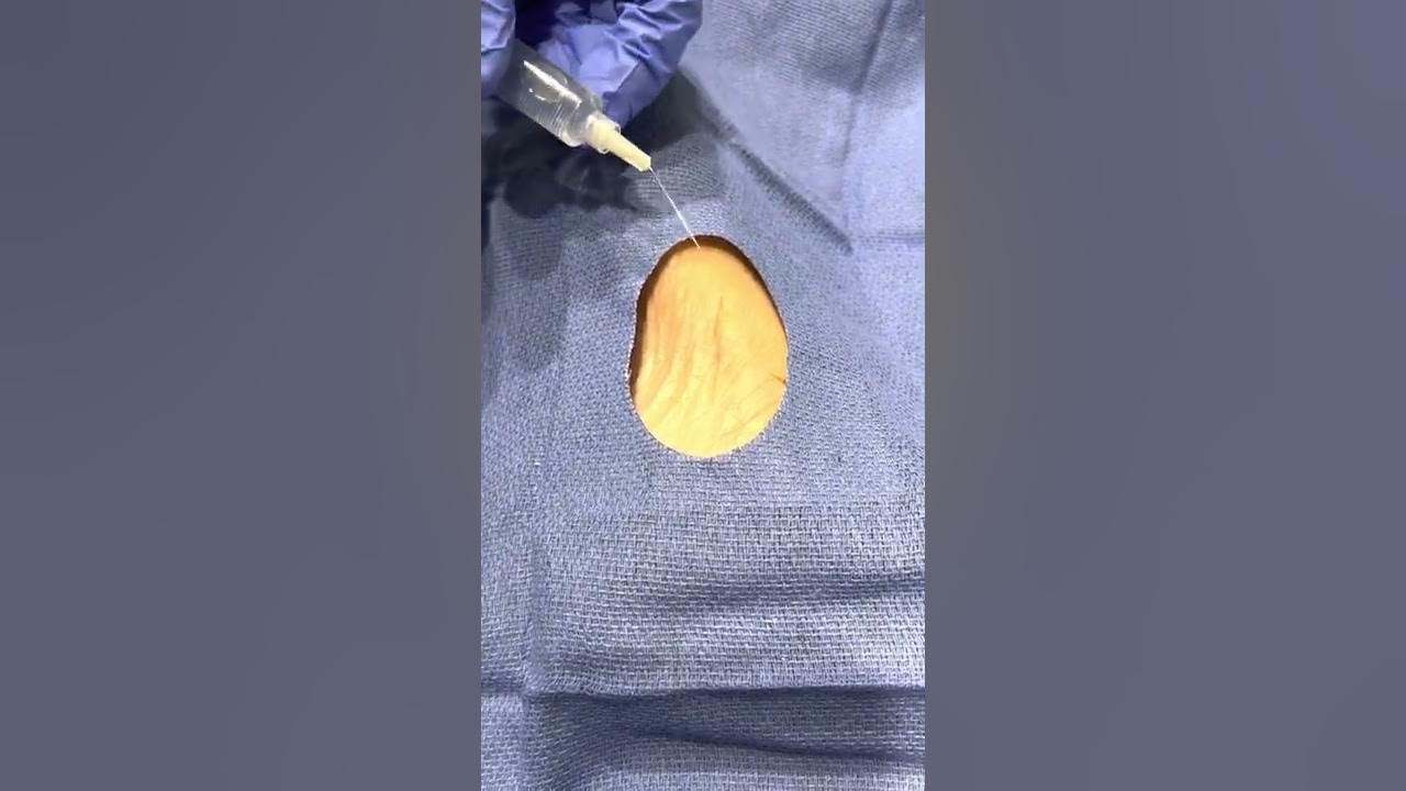 Injecting lidocaine YouTube