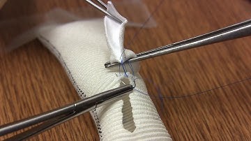 Parachute Anastomotic Technique