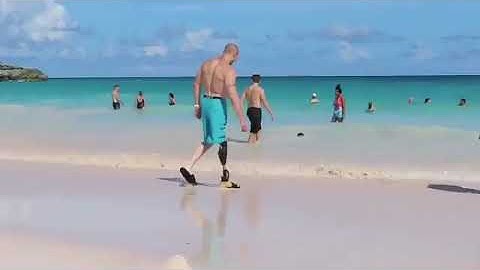 Jesse at 9 months post osseointegration surgery!