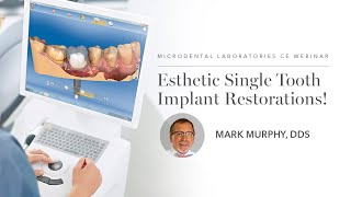 Celebrity Esthetic Single Tooth Implant Restorations   Jimmy Stegall, May 14th Profile