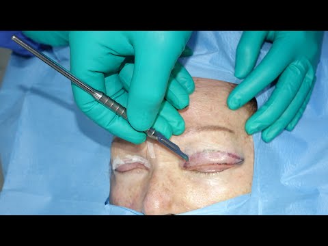 Gornja blefaroplastika i smanjenje masnih jastučića / Upper blepharoplasty and puffy eyes reduction