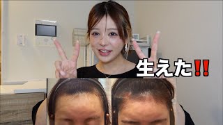 AGA治療1年 ハゲちゃんが全部話します