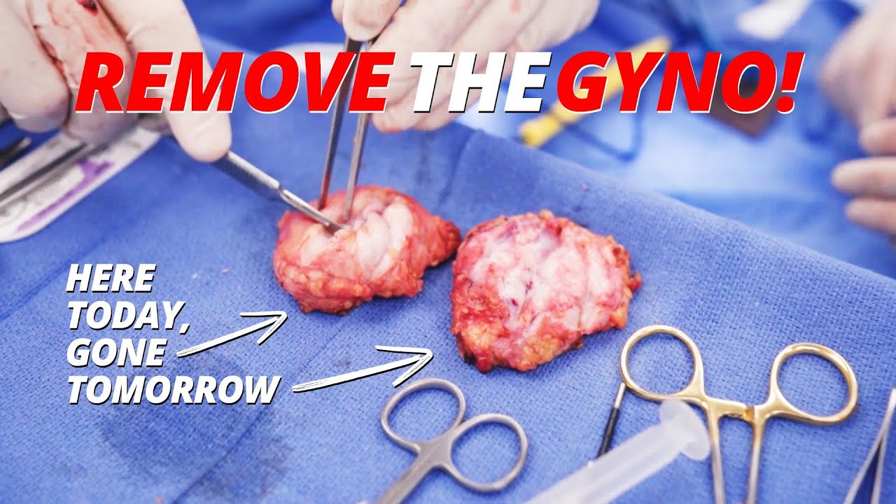 Massive Gynecomastia Surgery for Bodybuilder - Get Rid Of Gyno From Prohormones