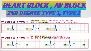 HEART BLOCK* AV BLOCK* SECOND DEGREE HEART BLOCK*MOBITZ 1 2 * أنسداد الدفيرة الكهربائية* أحصار القلب