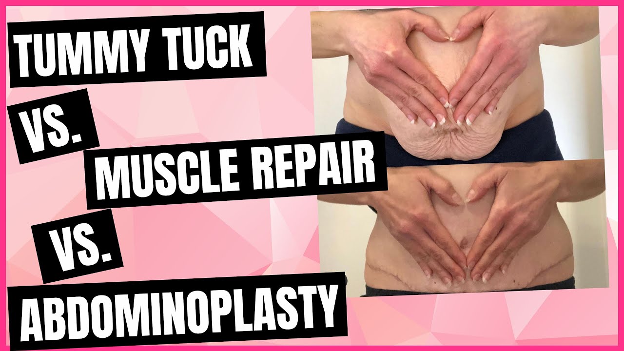 Tummy Tuck With Muscle Repair  Abdominoplasty vs Diastasis Recti Surgery  vs Tummy Tuck 