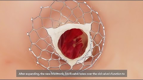 TAVR Patient Procedural Animation