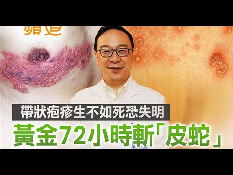 健康蘋道｜帶狀疱疹生不如死恐失明 黃金72小時斬「皮蛇」| 蘋果新聞網