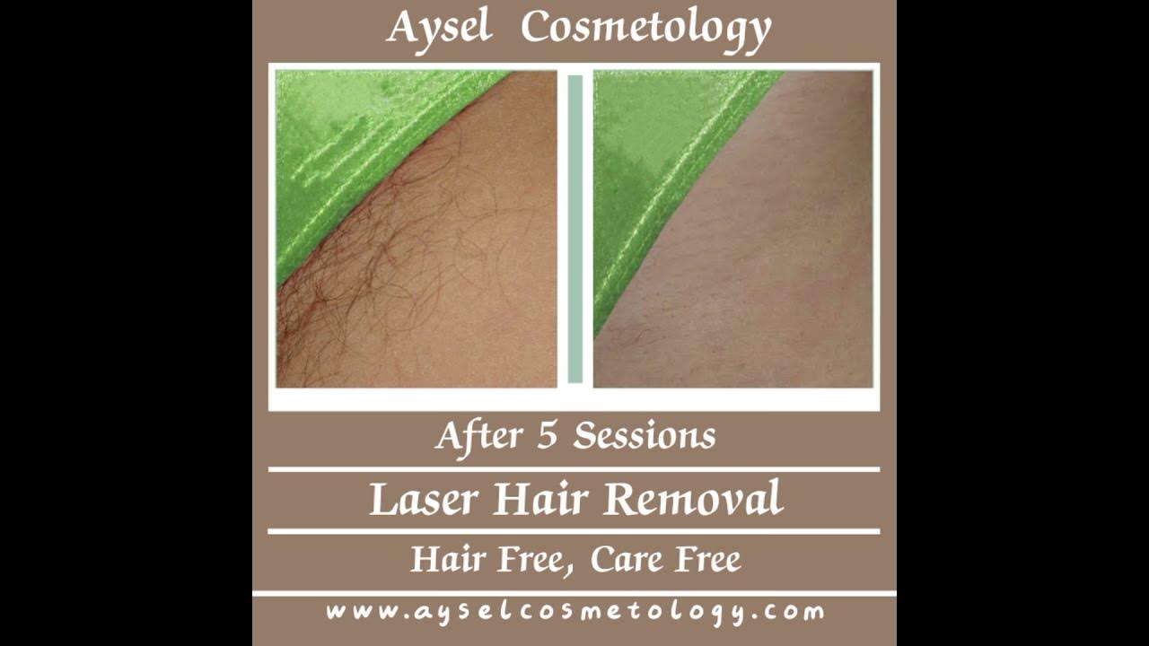 Laser Pubic Hair Removal. YouTube