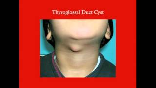 Thyroid - CRASH! Medical Review Series