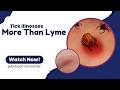 Tick Bites You’ll Never Notice