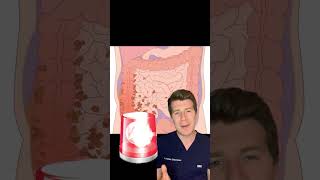 DOCTOR EXPLAINS APPENDICITIS IN UNDER 60 SECONDS #shorts #medical #doctor #health