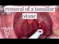 tonsil stone removal with ear curette