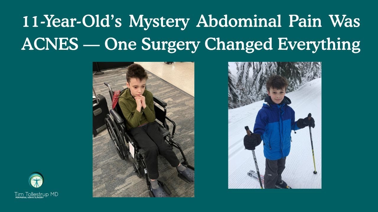 The Hidden Cause of His GI Pain: Anterior Cutaneous Nerve Entrapment