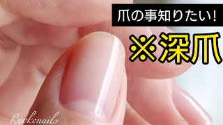 何故深爪になるまで切ってしまうのか？!Vol.83 Nail care