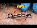 Extreme Satisfying Ingrown Hair Extraction – You Won’t Believe This!”