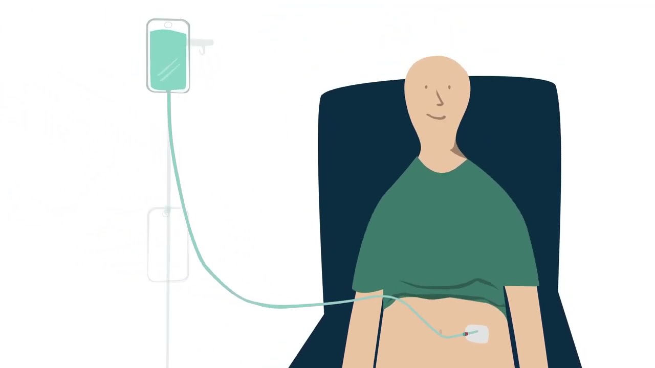 La Diálisis Peritoneal | ¿Qué es la DPCA?