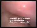 CPAP  on snoring and sleep apnea, how it actually works