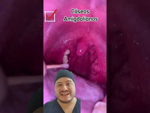 Vídeo: Como tratar úlceras de garganta (com fotos)