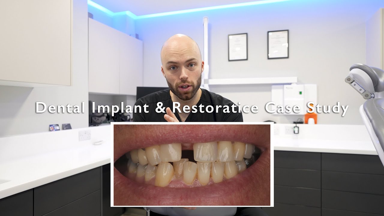 Case Study- Missing Front Tooth- Dental Implant & Restorative