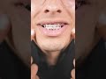 Can you eat with rubber bands?