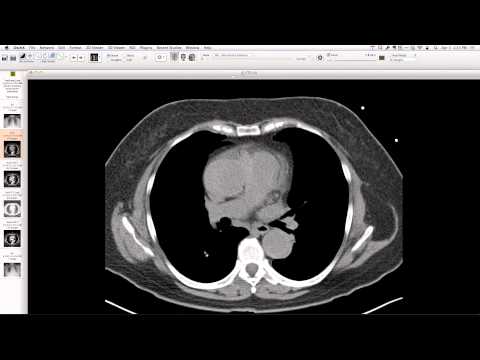 Complex Congenital Anomalies: Right Aortic Arch with Aberrant Innominate Artery, Total Anomalous Pulmonary Venous Return of Left Lung, and Cor Triatriatum Sinister