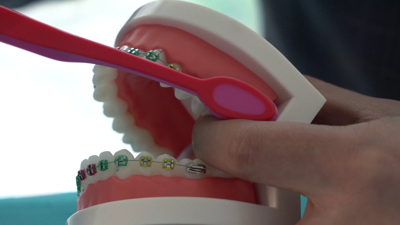 الطريقه الصحيحه لتفريش الاسنان بوجود التقويم - د. سلمان سالم صرخوه