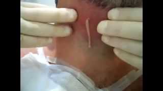 Sebaceous cyst full of pus