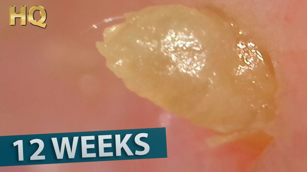 6 big blackhead removal grown for about 12 weeks youtube