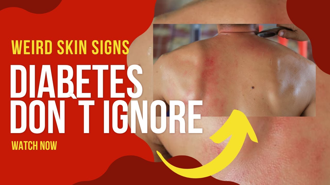 Spotting Diabetes Skin Signs You Shouldn’t Ignore