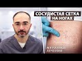 Эффективные и безопасные способы лечения сосудистых звездочек на ногах