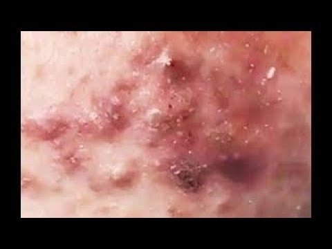 Acne under the skin | 여드름 피부 아래 | 肌の下にきび | Прыщи под кожей