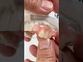 Flexible partial that we just comp in our lab for Dr. Marlen Martirossian in New Jersey