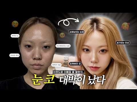Fixing a tired-looking face with revision eye surgery and hump correction, pre-op to 3 months